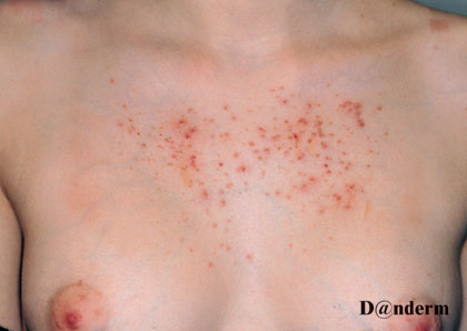pityrosporum folliculitis