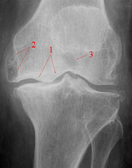 knae-gigt-gonartrose alvorlig-rtg