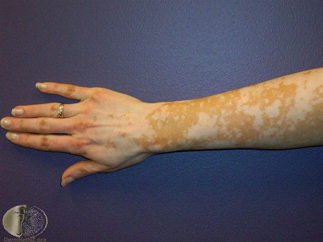 vitiligo-arm
