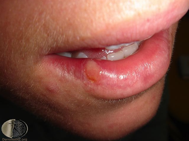 herpes simplex labialis1