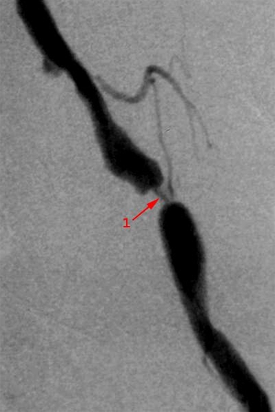 hjerte-kar-baekkenarterie-stenose-rgt