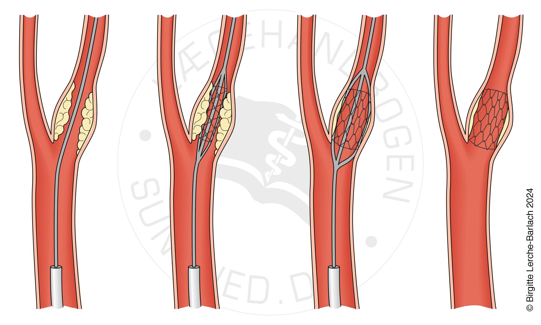 aarer-carotis angioplastik