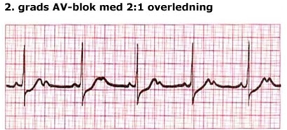 av blok grad 1-ekg