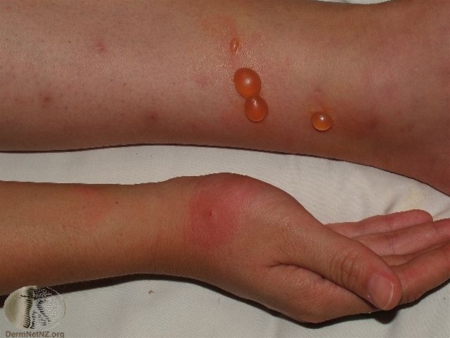 myggestik bulloes reaktion-blaeredannelse