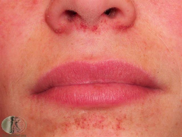 tuberoes sklerose angiofibrom tidlig fase