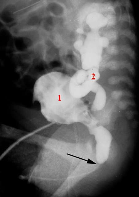 urethra-klap-roentgen