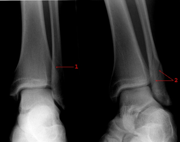 ankel-malleolfraktur-roentgen