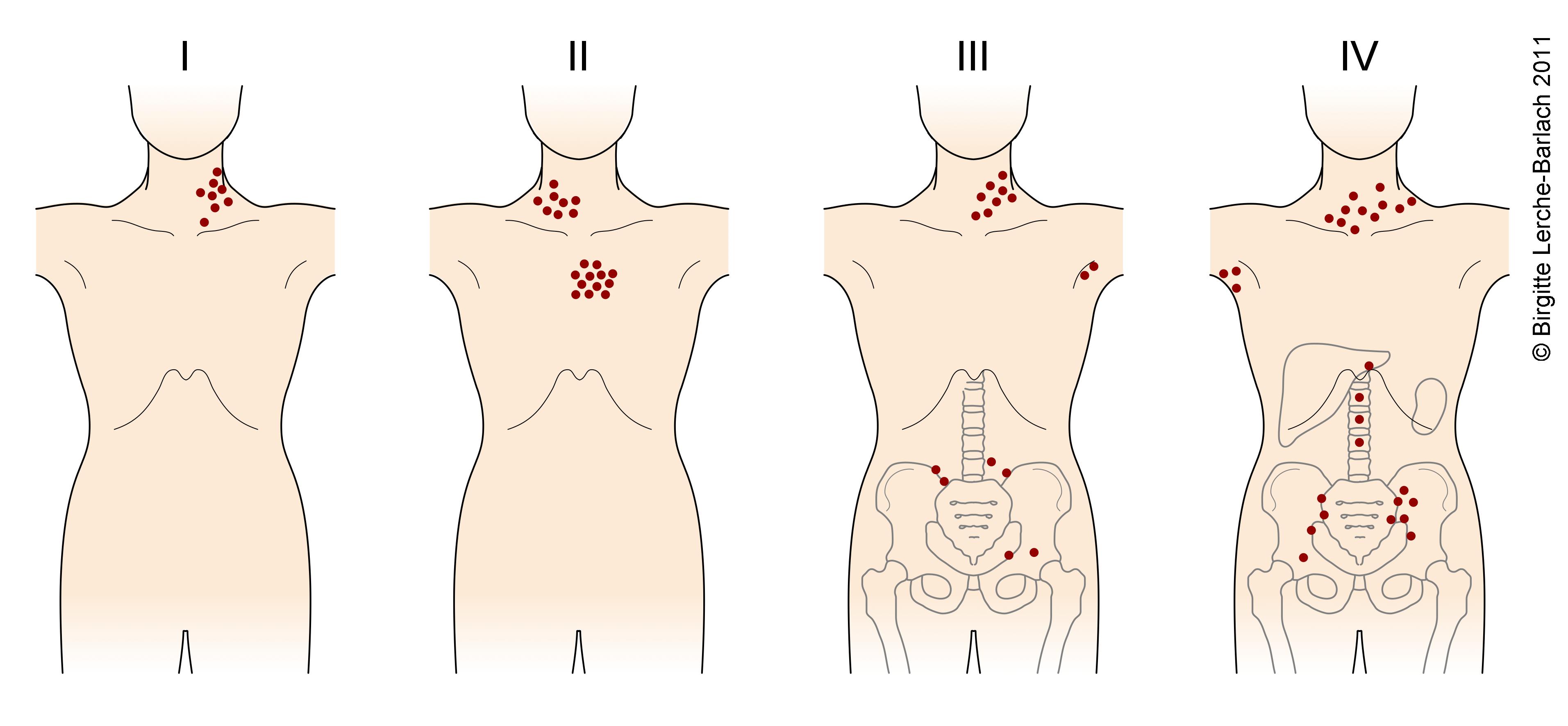 stadieinddeling af mb hodgkins