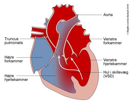 Tegning af hjerte med ventrikelseptumdefekt.