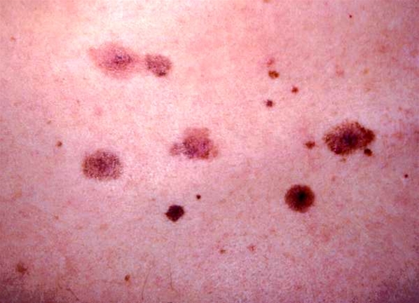 naevi irregulaere pigmenterede-hud