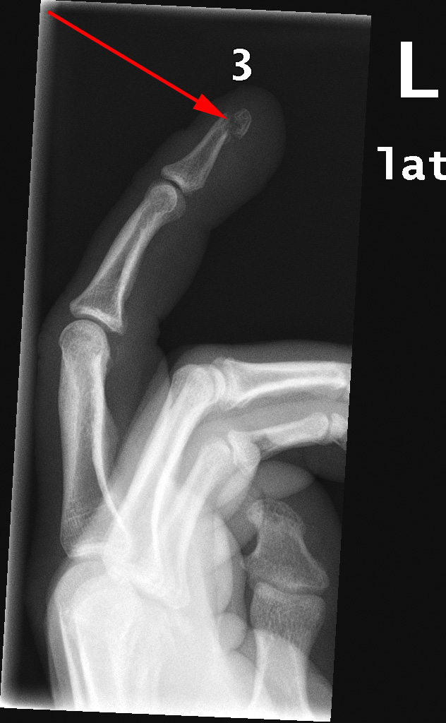 haand-fingerfraktur-roentgen