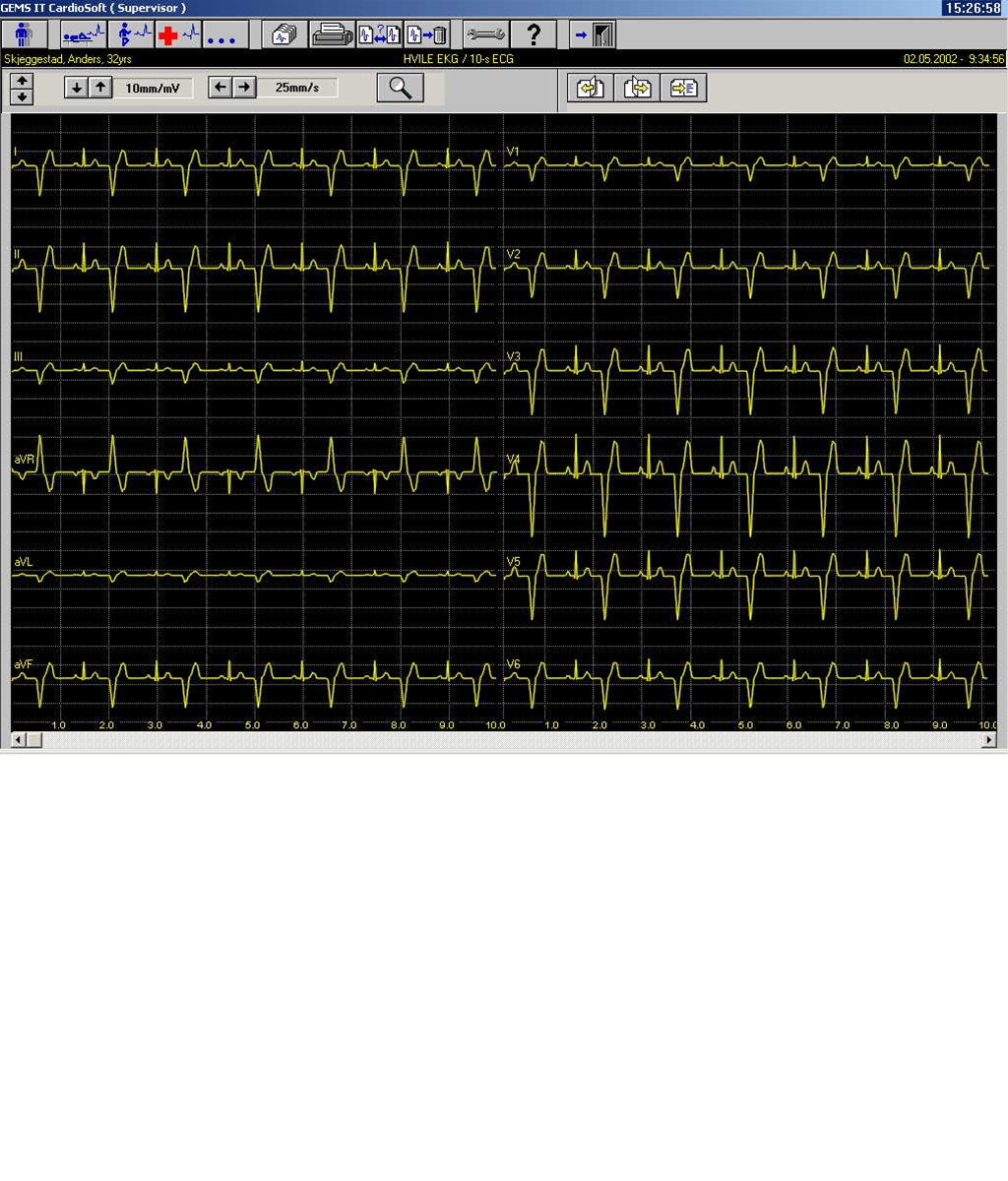 hjerte-ventrikulaer bigemini-ekg