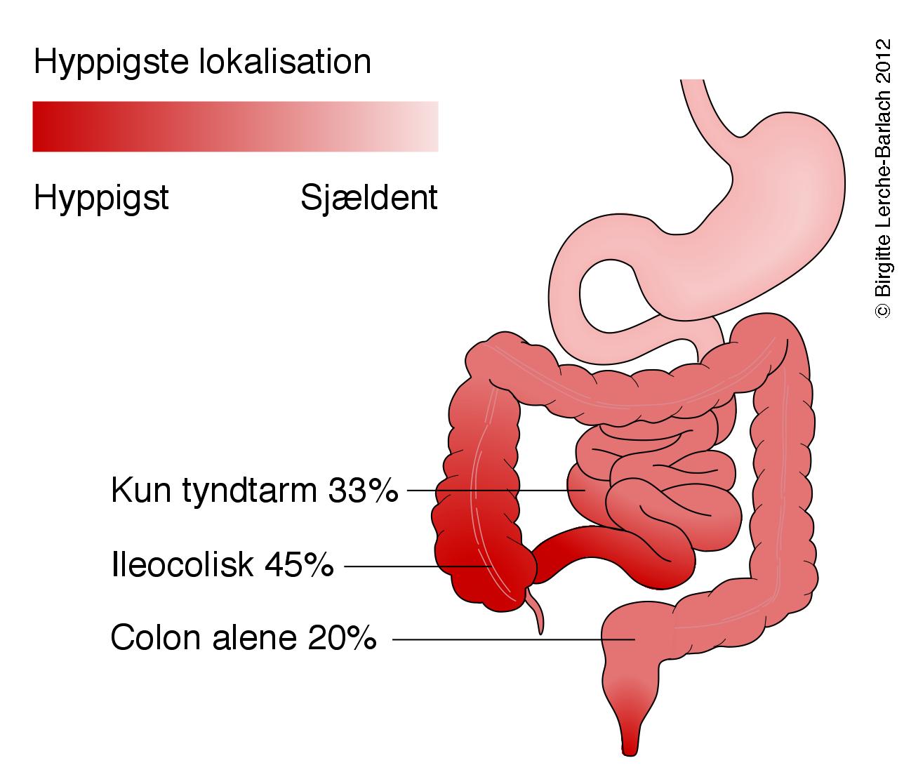 tarm-crohns sygdom anatomisk fordeling