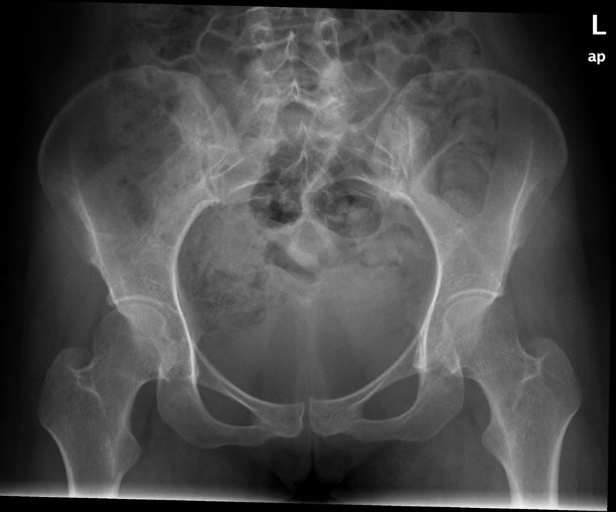 baekken normalt roentgen