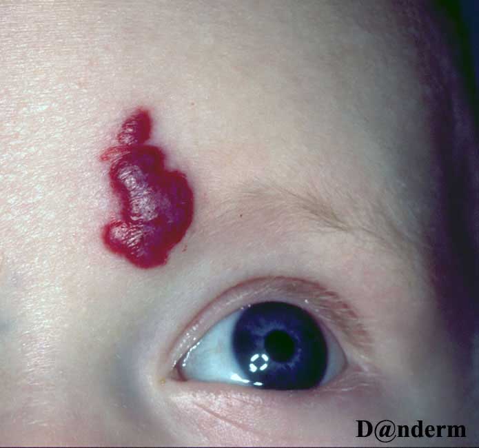 Cavernous hemangioma_aktuelt anvendes ikke