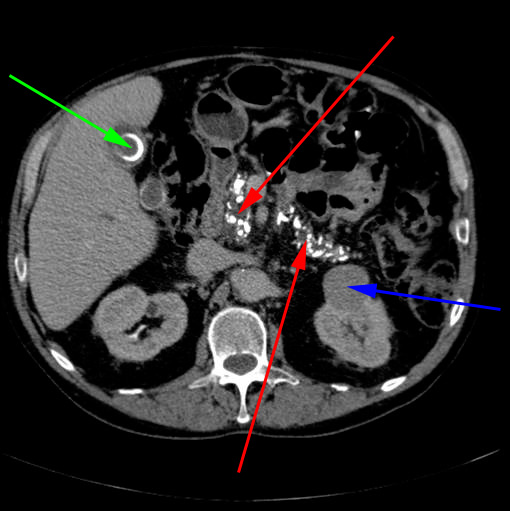 pankreas-kronisk pankreatitis cyste i nyre og galdesten-ct