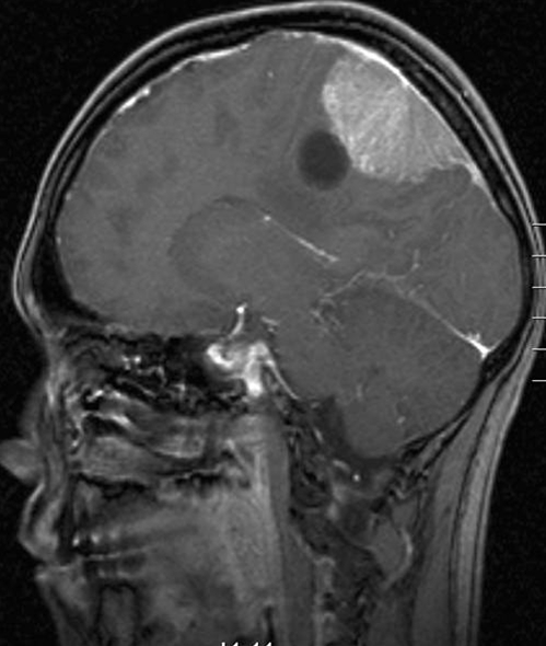 hjerne-meningiom med cyste-1-mr