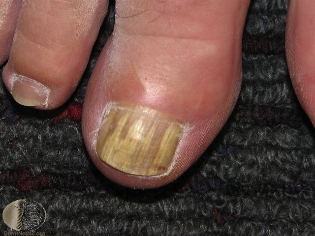 neglsopp trichophyton rubrum