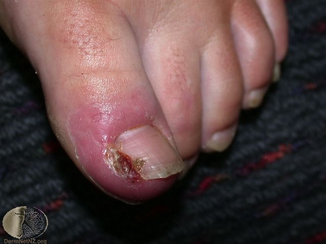 indgroet taanegl betaendt 2