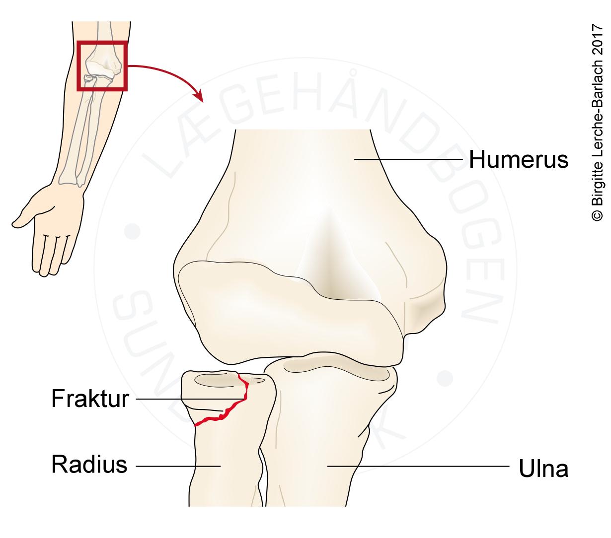 LH8044Caput radii fraktur albue