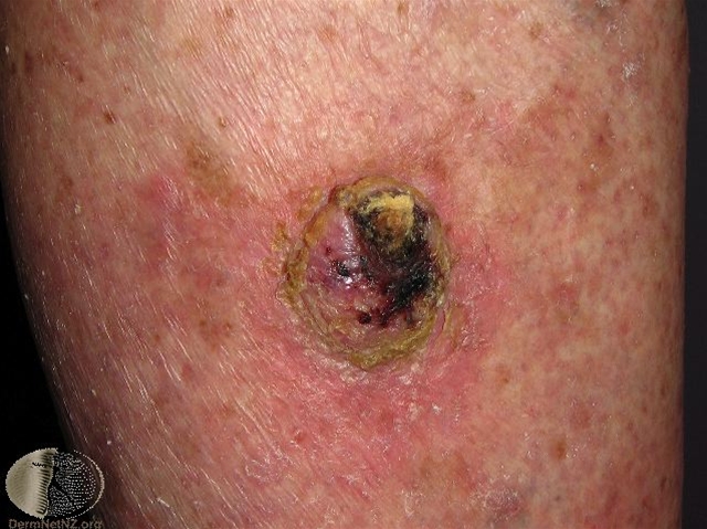 spinocellulaer cancer invasiv