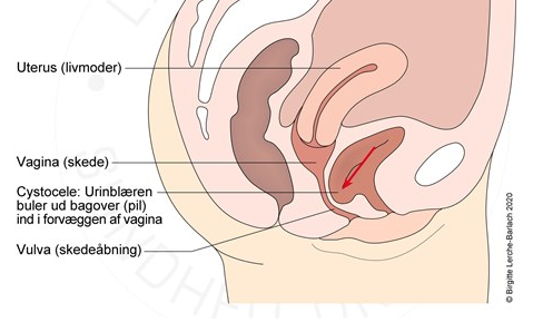 underliv-cystocele