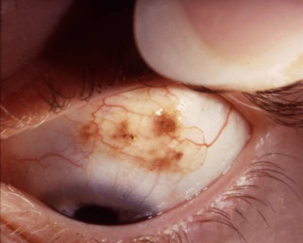 oeje-conjunctivale naevi