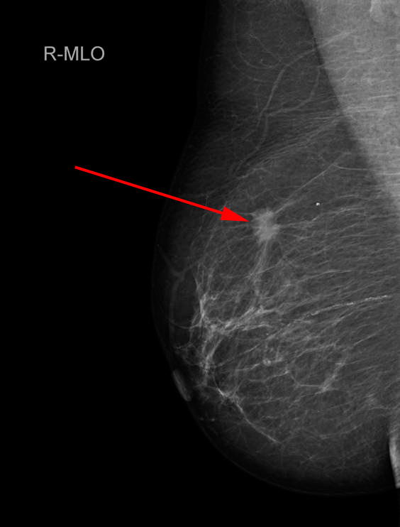 bryst-malign tumor hoejre-mammografi