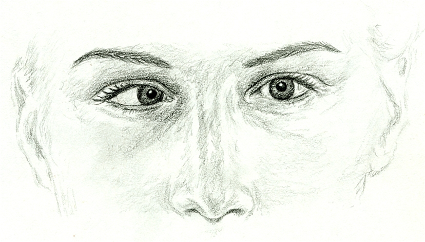 oejne-konvergerende skjeling hoeyre oeyet