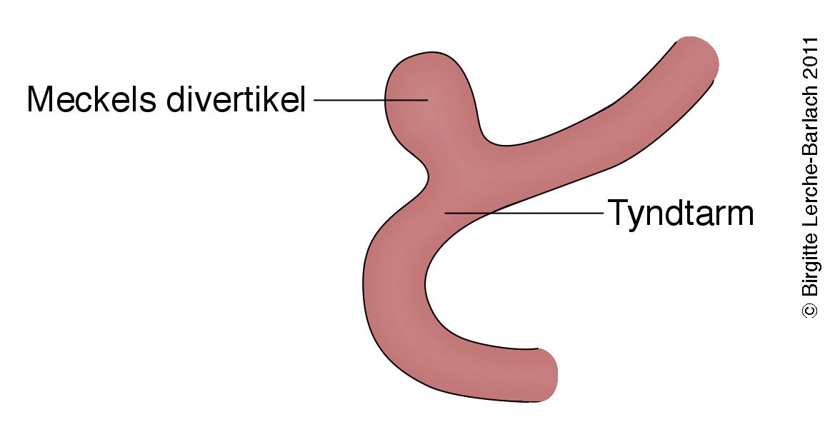 tyndtarm-meckels divertikel