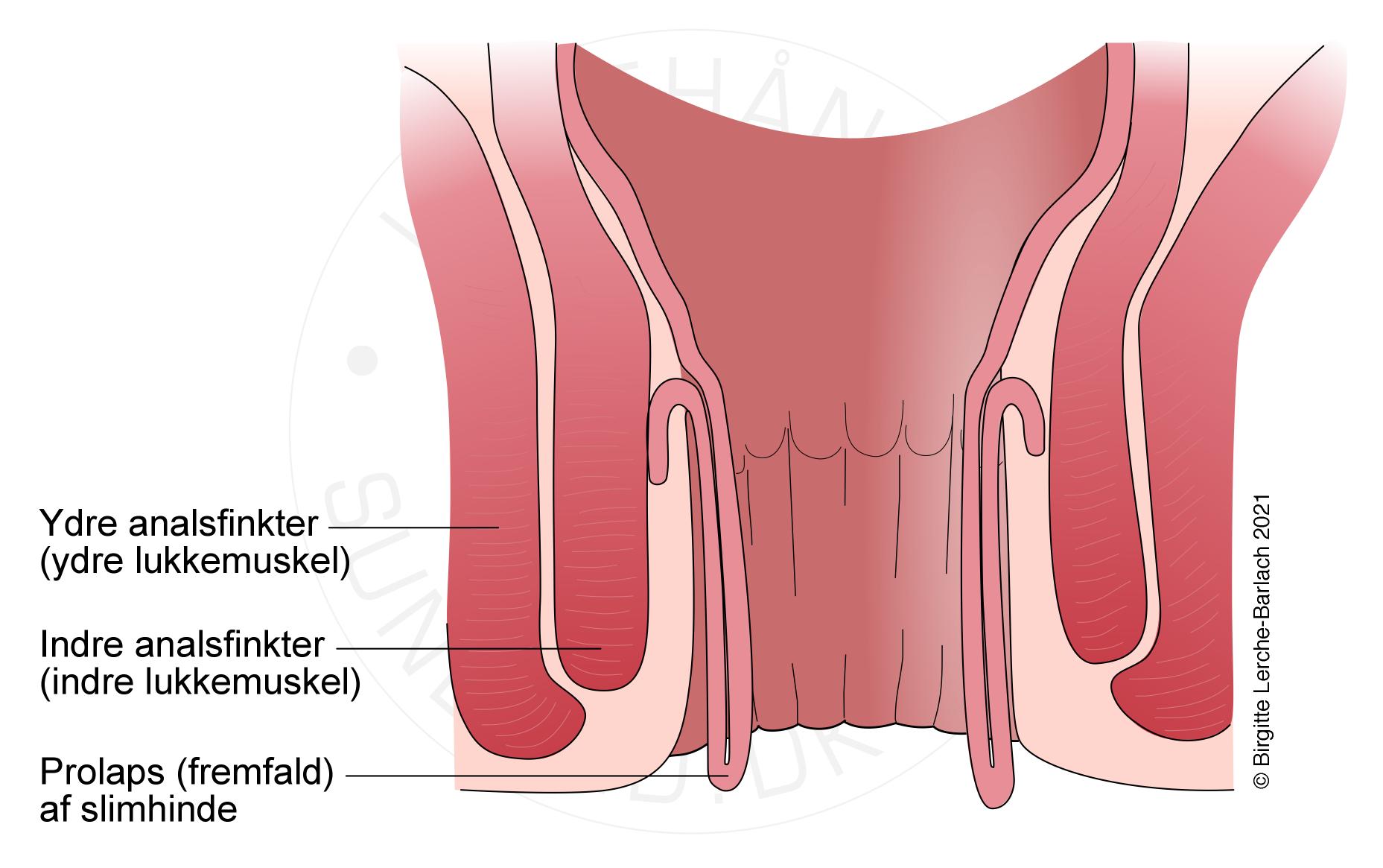 rektum-rektalslimhindeprolaps
