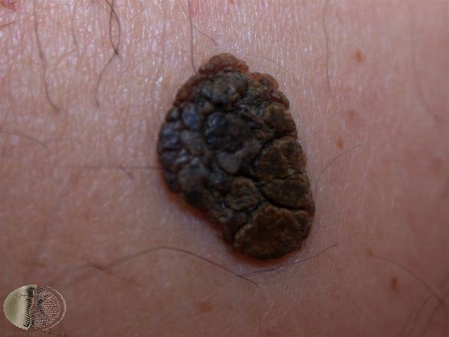 4198 2 seboroiske vorter 2 jpg