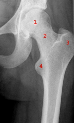 hofte-normal-front-roentgen