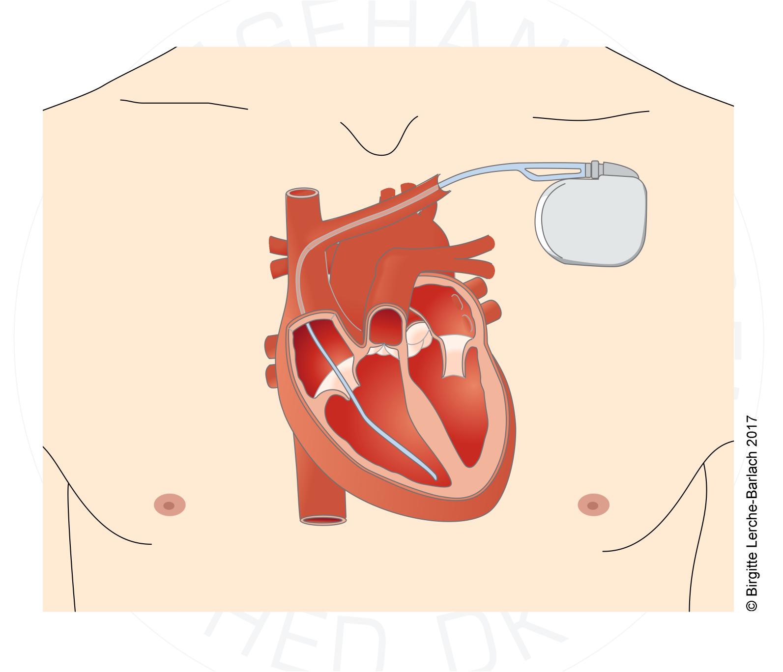 Hjertestarter ICD implanterbar