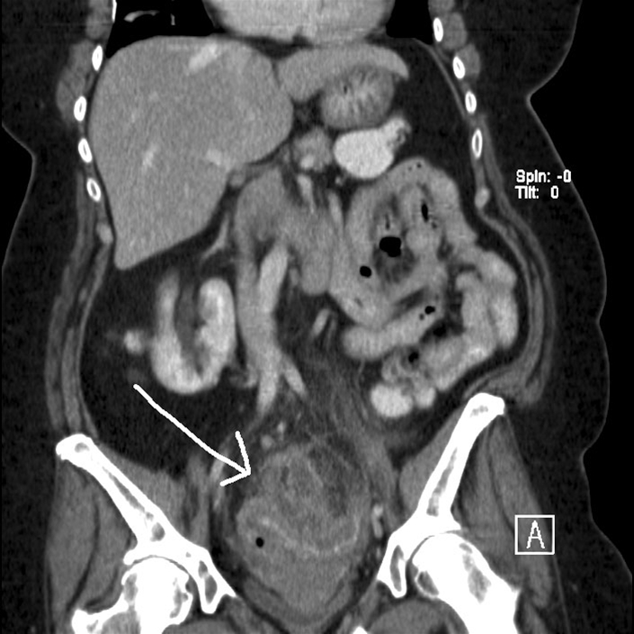 colon sigmoideum laengdesnit-divertkel sygdom-ct