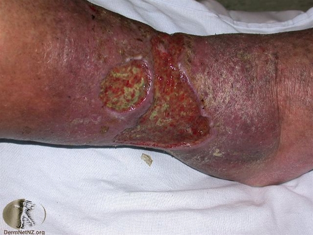 ben-bensaar kronisk venoest