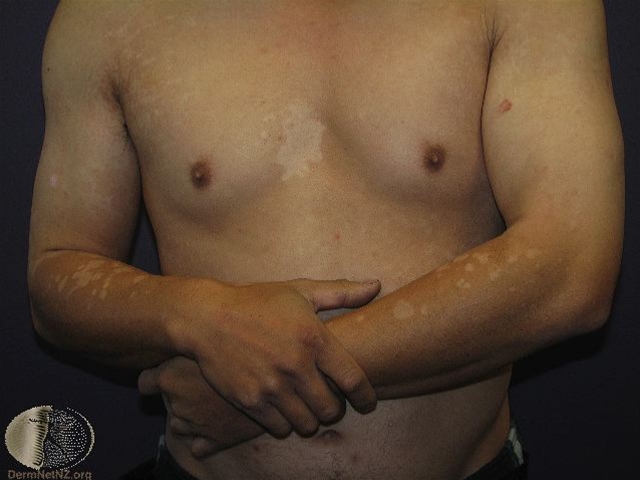 pityriasis-versicolor-hypopigmenteret