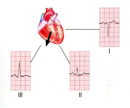 hoejre aksedeviation-ekg
