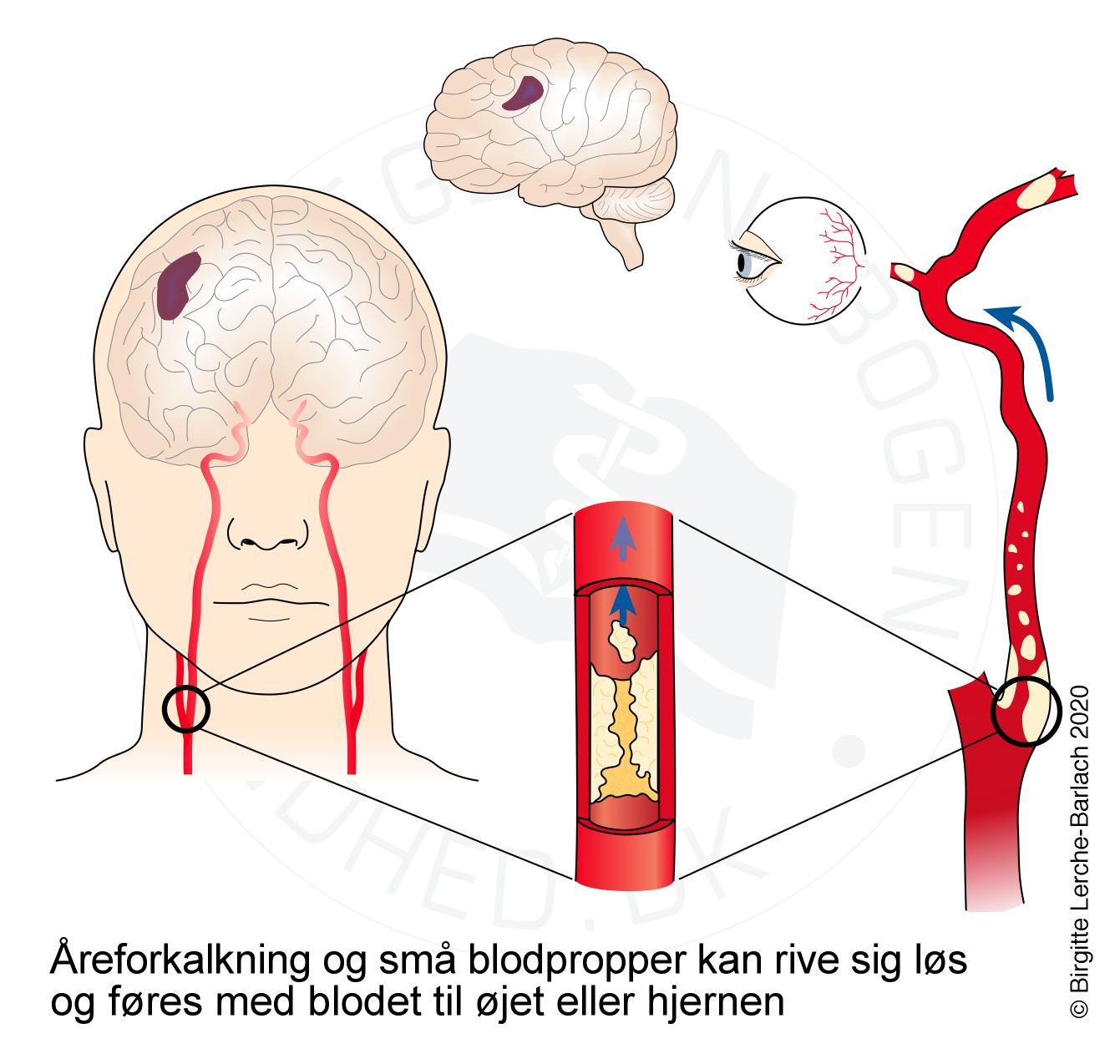 aarer-carotis stenose