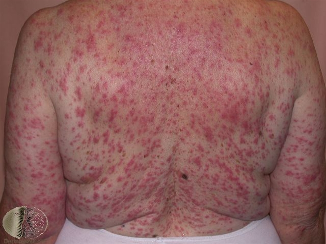 medikamentelle eksantemer morbiliform-2