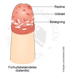 Tegning der viser forhudsbetændelse med rødme, udslet og eventuelt belægninger