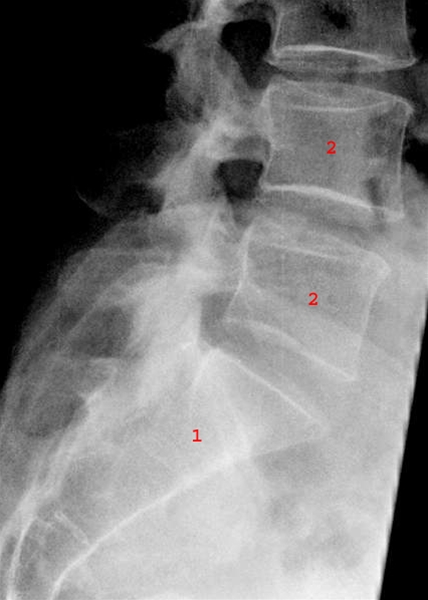 ryg-lumbosacralcolumna side-roentgen