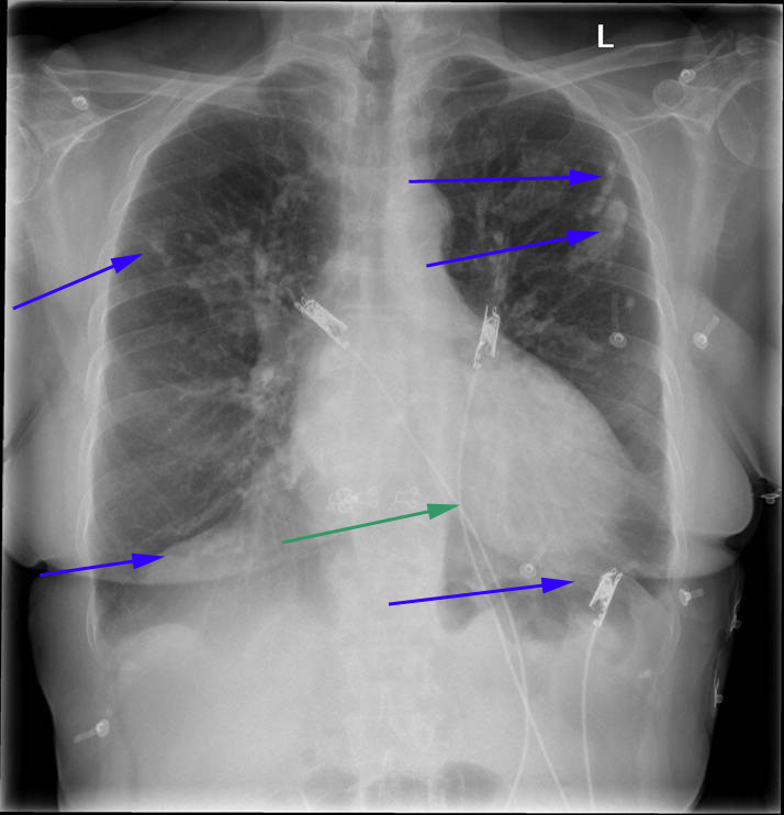 lunger-lungebetaendelse og asbestud-roentgen