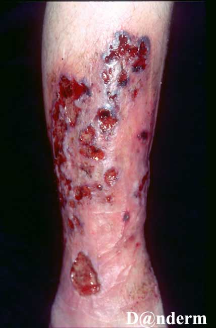 pyoderma gangrenosum