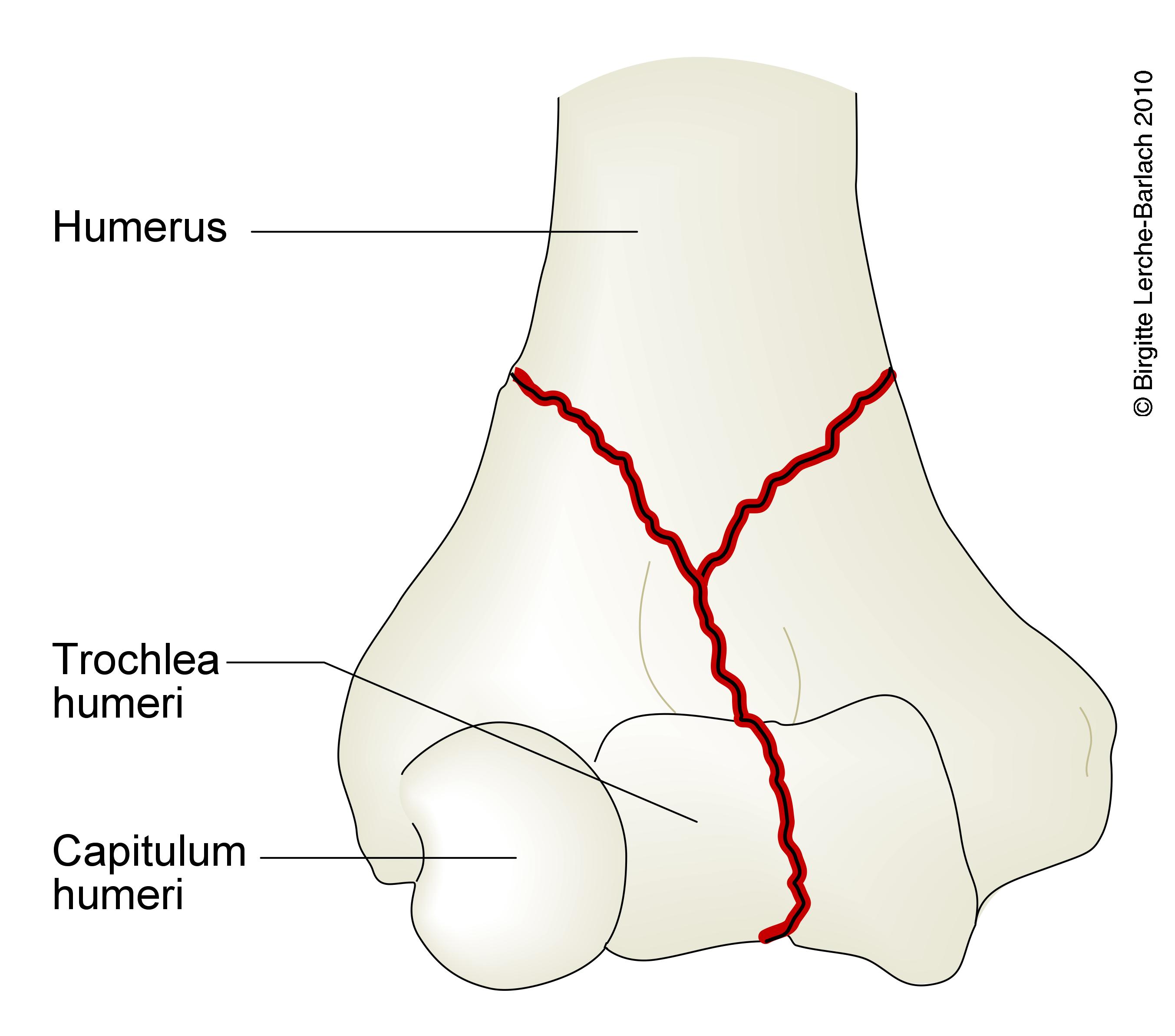 overarm-fraktur transkondylaer humerus 2 7324
