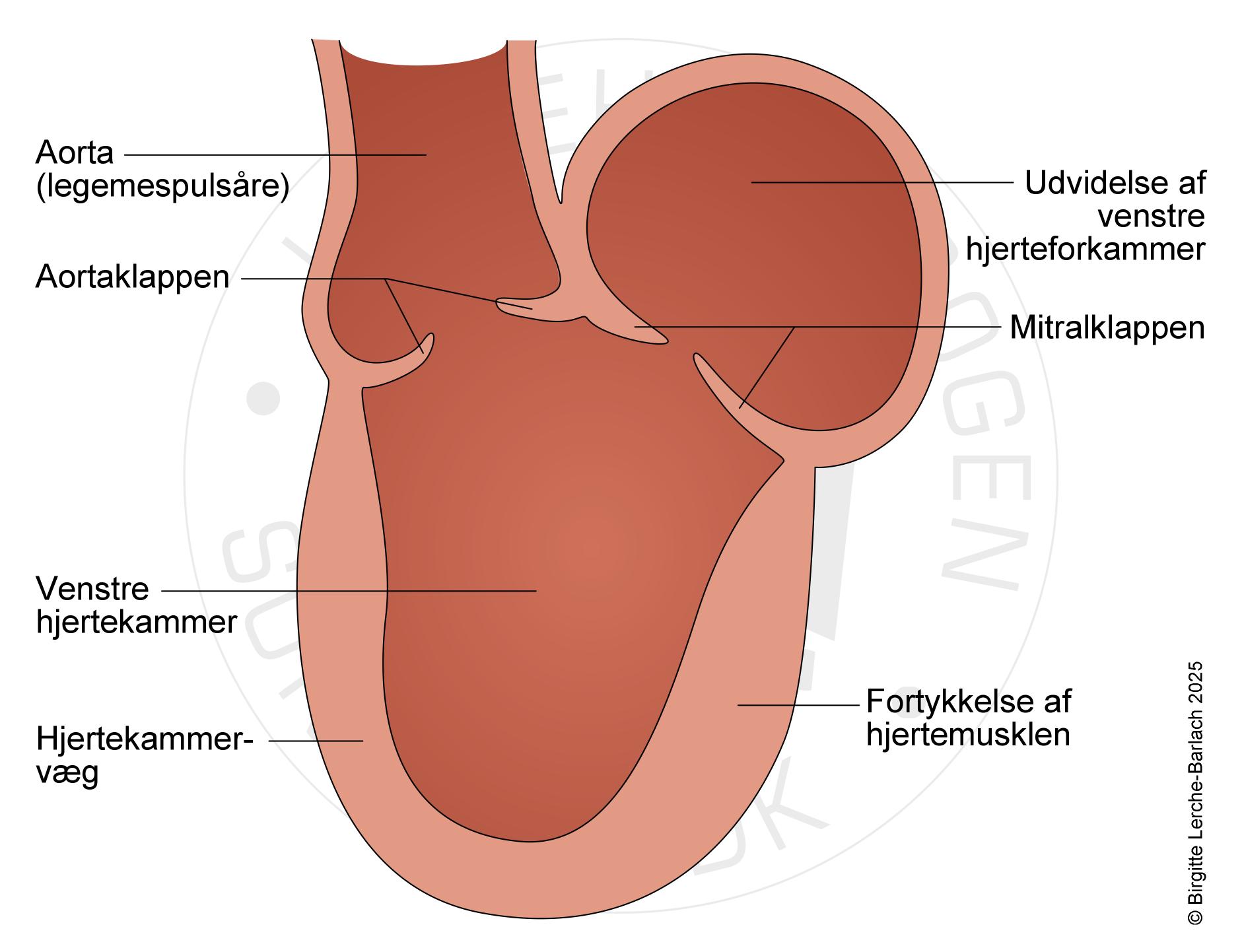 ventrikelkardiomyopati ved diabetes