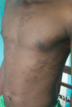 Foto af pityriasis versicolor på kroppen