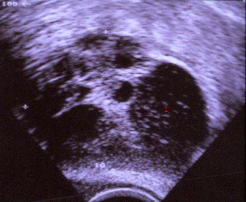 aeggestokke-dermoid cyste-ultralyd