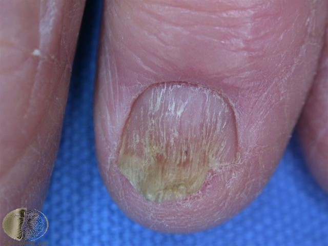 lichen planus negl