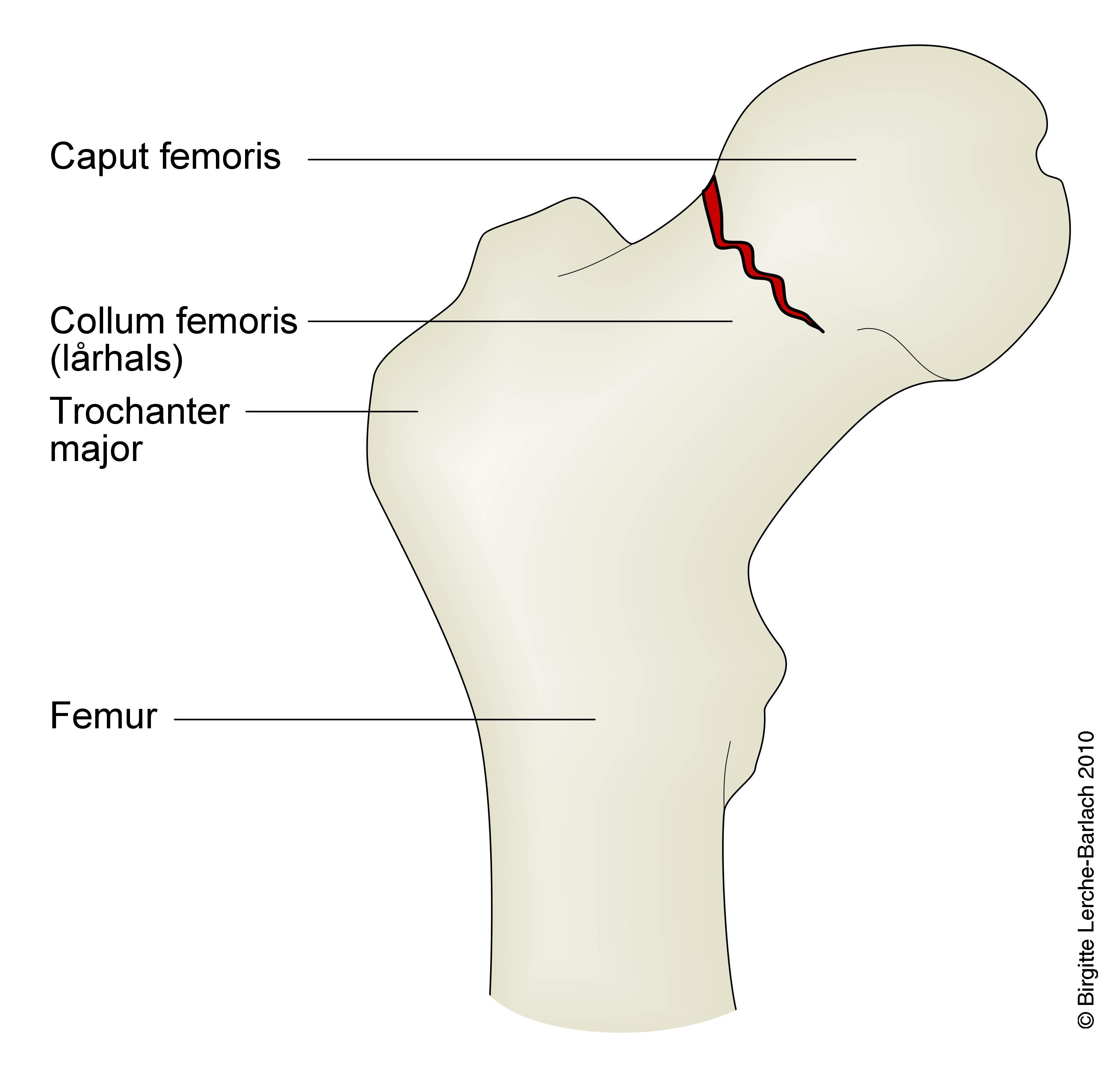 laarhals-fraktur collum femoris indkilet